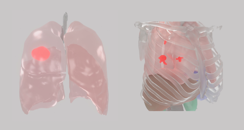 Drug revival lung