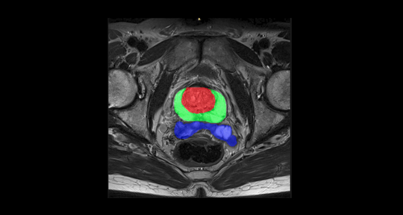 Prediction Of Metastatic Relapse In Intermediate/high Risk Localized ...