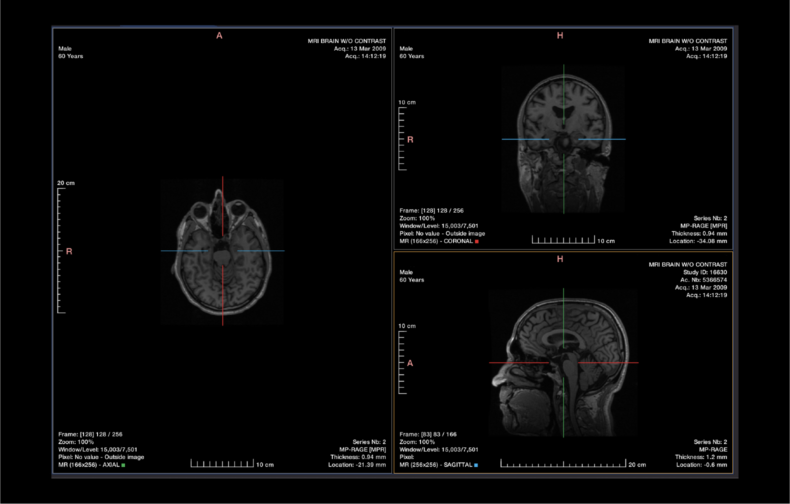 AI-based MRI Brain medical device | QP-Brain