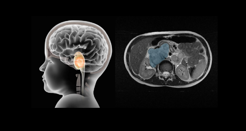 Image 02 pediatric oncology CS