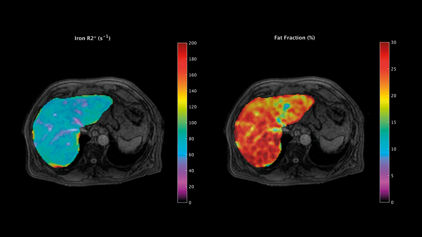 Advancing Liver Disease Assessment In Automatic Liver Segments