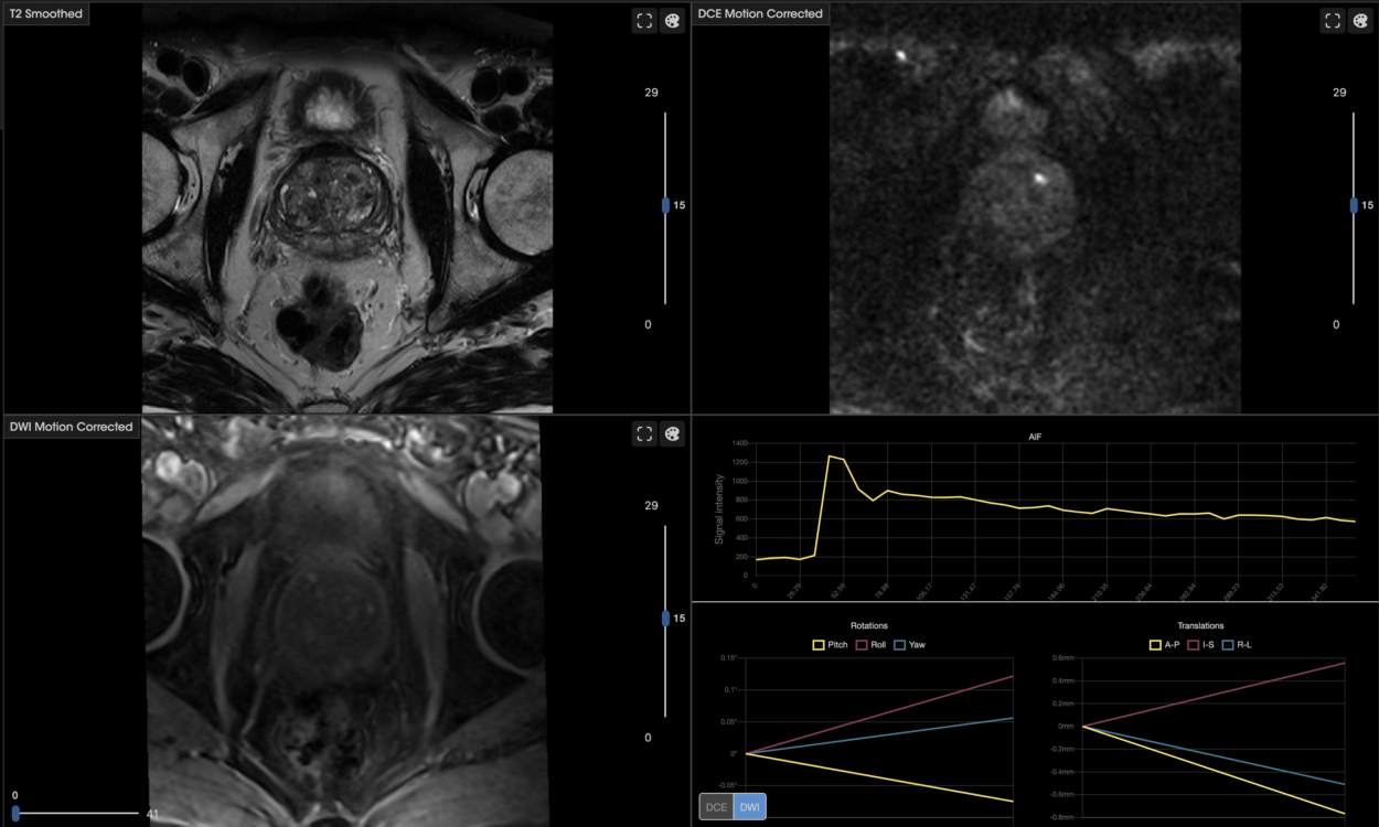 Advanced Imaging Biomarkers in Prostate Cancer