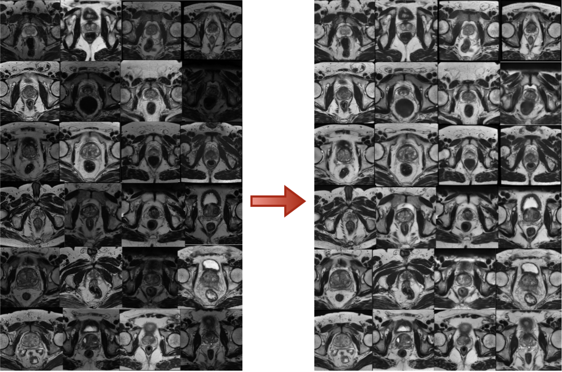 MRI image harmonization