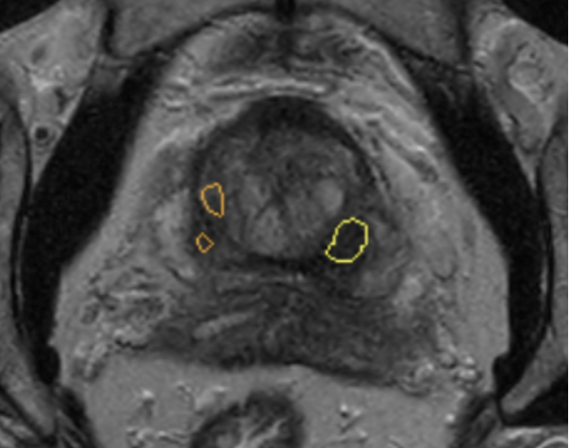 suspicious lesion on prostate