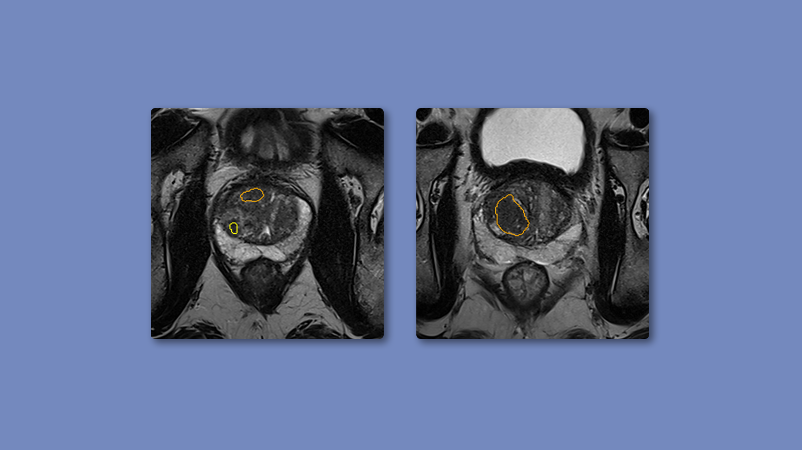 Developing And Validating AI Algorithms In Prostate MRI - Quibim