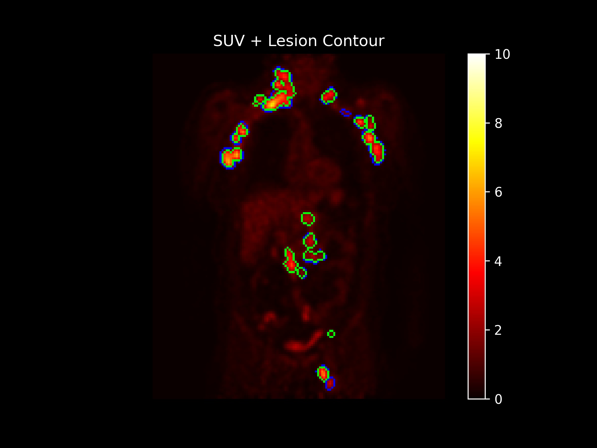 The SUV parametric map with the contoured lesions is also shown. The area delineated in blue shows the lesion contour, while the area delineated in green represents the isocontour of 41% of the SUVmax of each lesion.