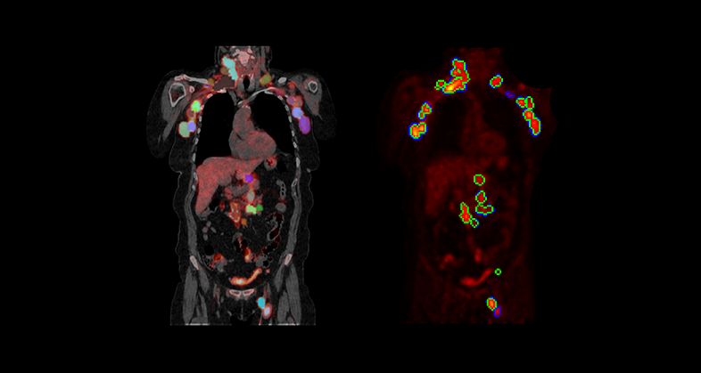 240709_Predicting-survival,-neurotoxicity,-and-response-in-B-Cell-lymphoma-patients-treated-with-CAR-T-therapy-using-an-imaging-features-based-model_small