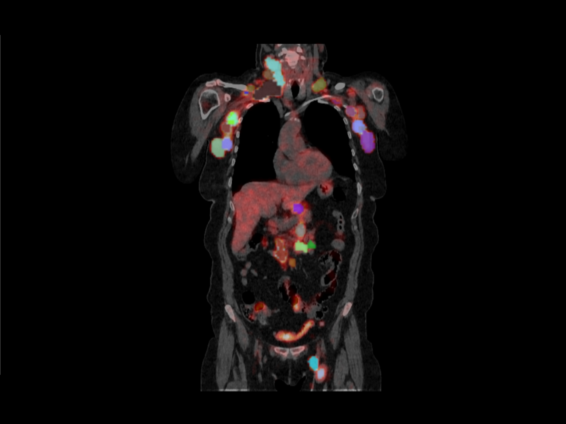 A pre-lymphodepletion coronal PET/CT image of an included subject is presented, showing metabolically active lesions segmented in 3D using a 41% SUVmax threshold.