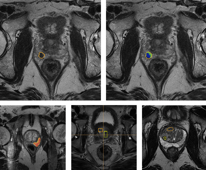 qp-prostate_seg_det_v6-3